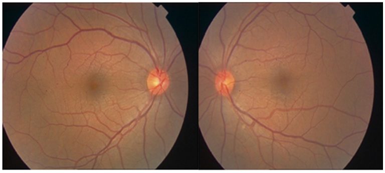 Topiramate Induced Bilateral Simultaneous Angle Closure Glaucoma in A ...